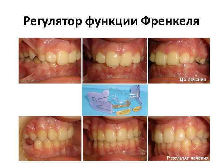 Регулятор функции Френкеля 