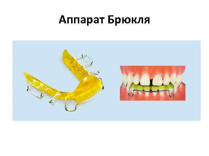 Внеротовые ортодонтические аппараты презентация