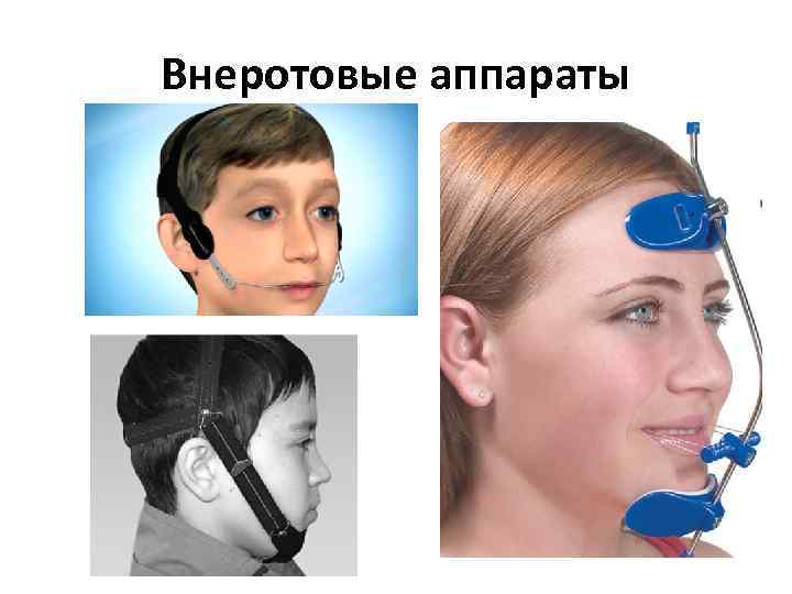 Внеротовые аппараты 