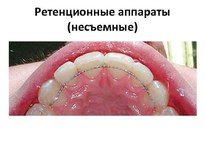 Ретенционные аппараты (несъемные) 
