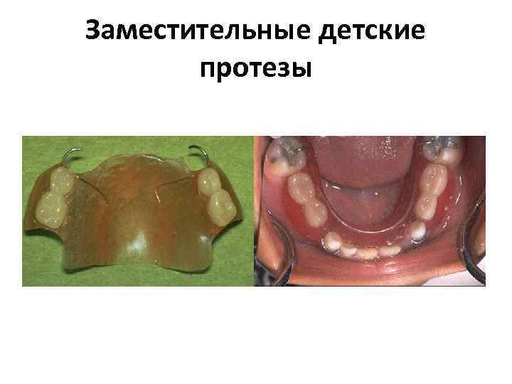 Заместительные детские протезы 