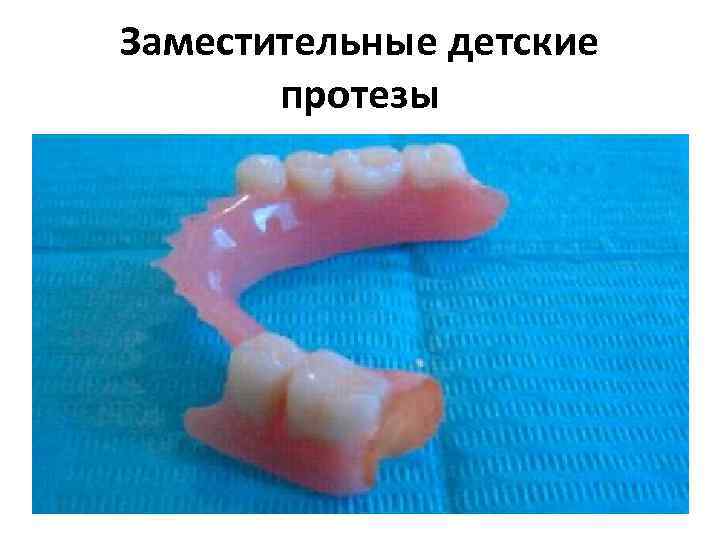 Заместительные детские протезы 