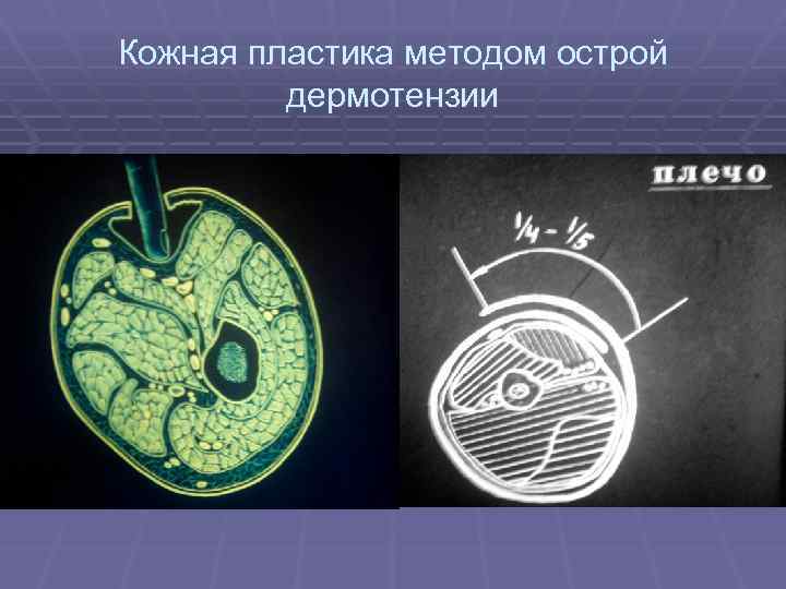Кожная пластика методом острой дермотензии 