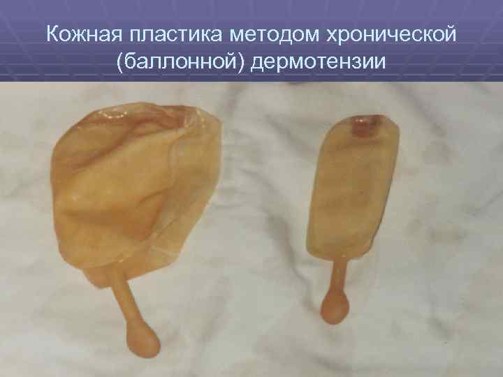 Кожная пластика методом хронической (баллонной) дермотензии 