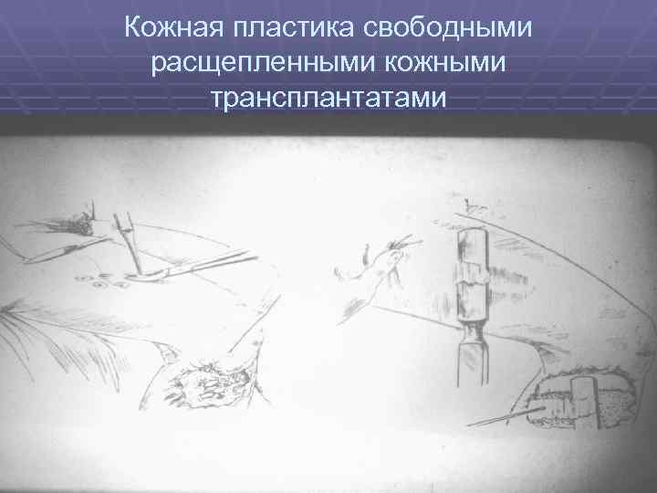 Кожная пластика свободными расщепленными кожными трансплантатами 