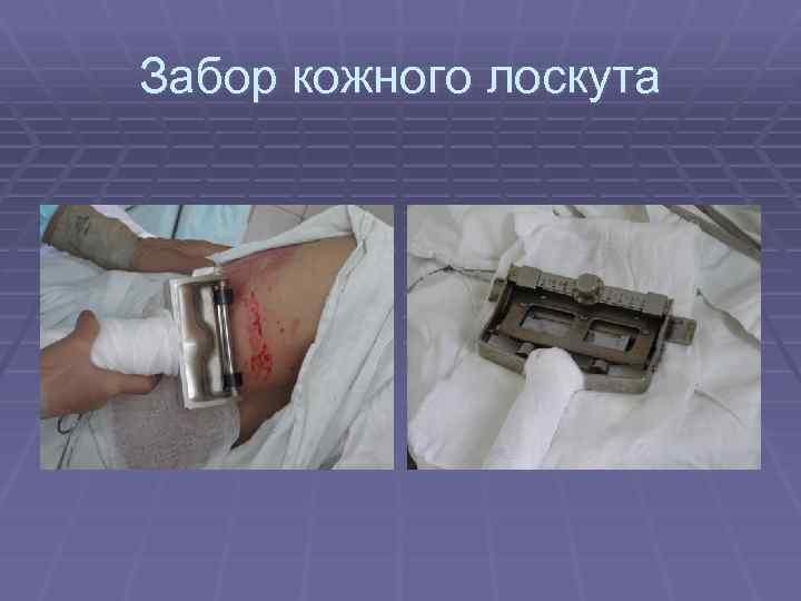 Забор кожного лоскута 