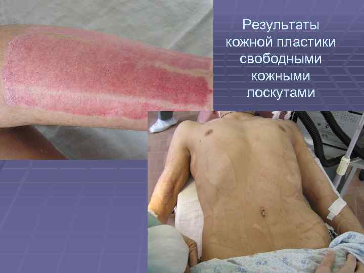 Результаты кожной пластики свободными кожными лоскутами 