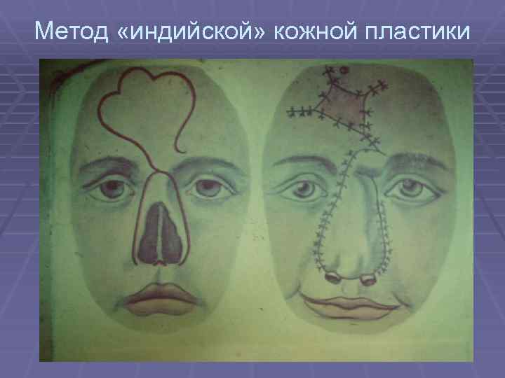 Метод «индийской» кожной пластики 