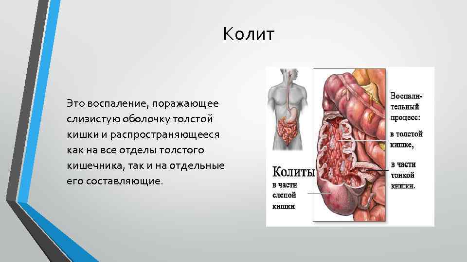 Колит Это воспаление, поражающее слизистую оболочку толстой кишки и распространяющееся как на все отделы