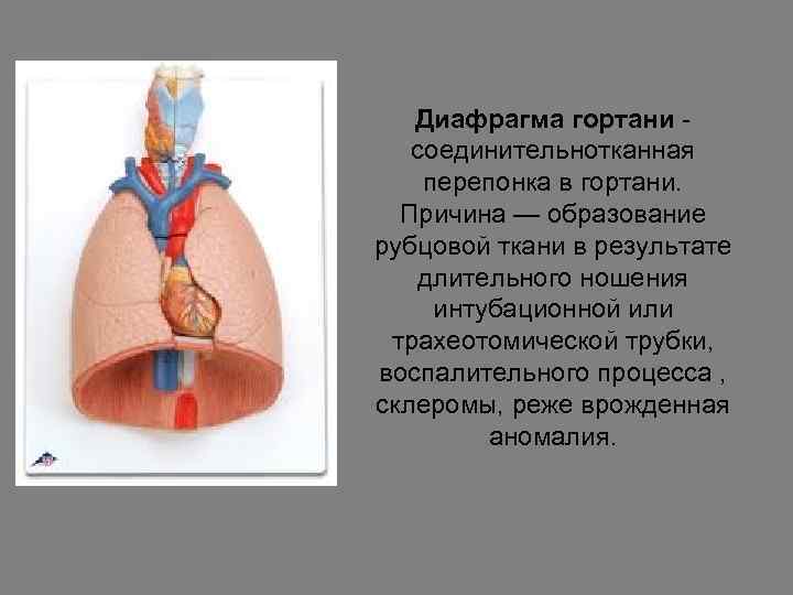 Диафрагма гортани - соединительнотканная перепонка в гортани. Причина — образование рубцовой ткани в результате