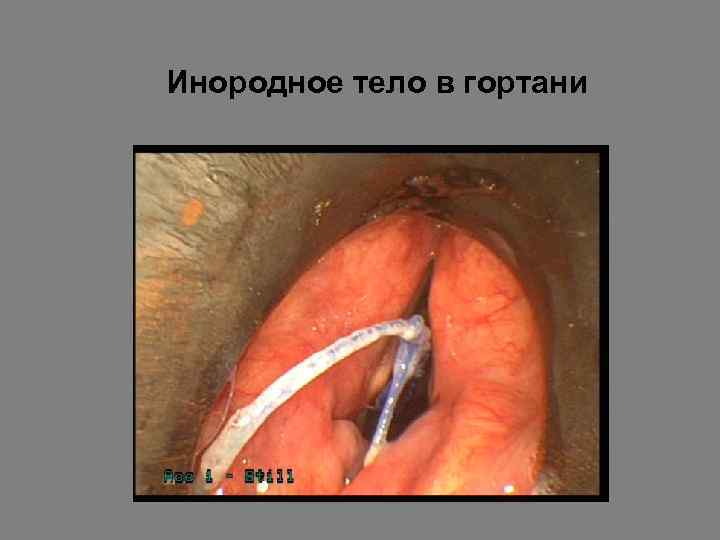 Инородное тело в гортани 