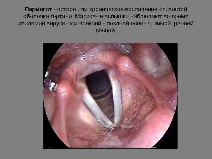 Ларингит - острое или хроническое воспаление слизистой оболочки гортани. Массовые вспышки наблюдают во время