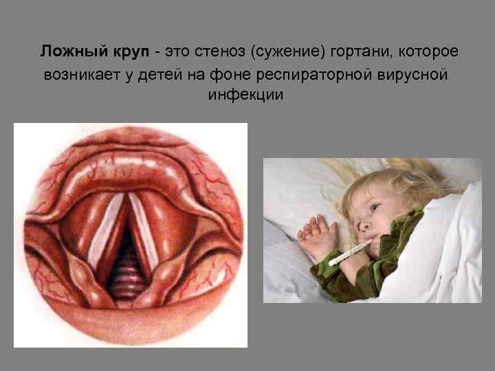  Ложный круп - это стеноз (сужение) гортани, которое возникает у детей на фоне