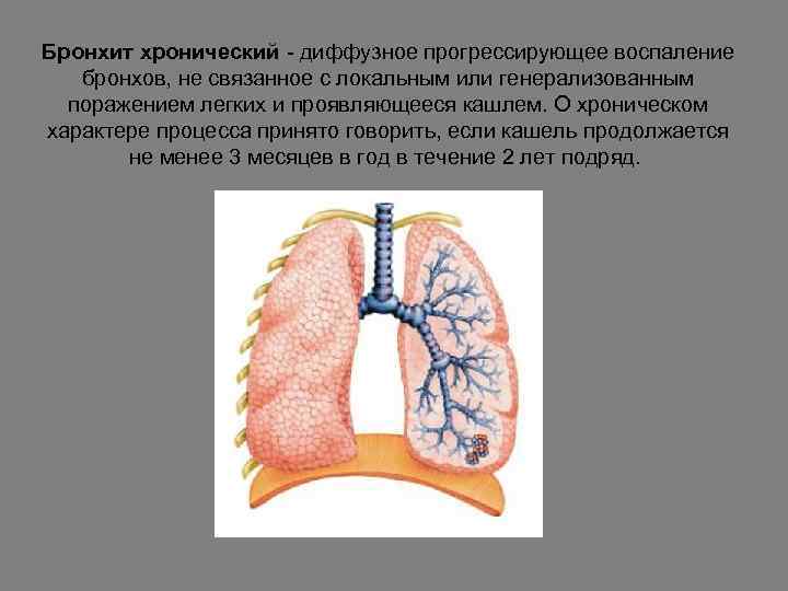 Бронхит хронический - диффузное прогрессирующее воспаление бронхов, не связанное с локальным или генерализованным поражением
