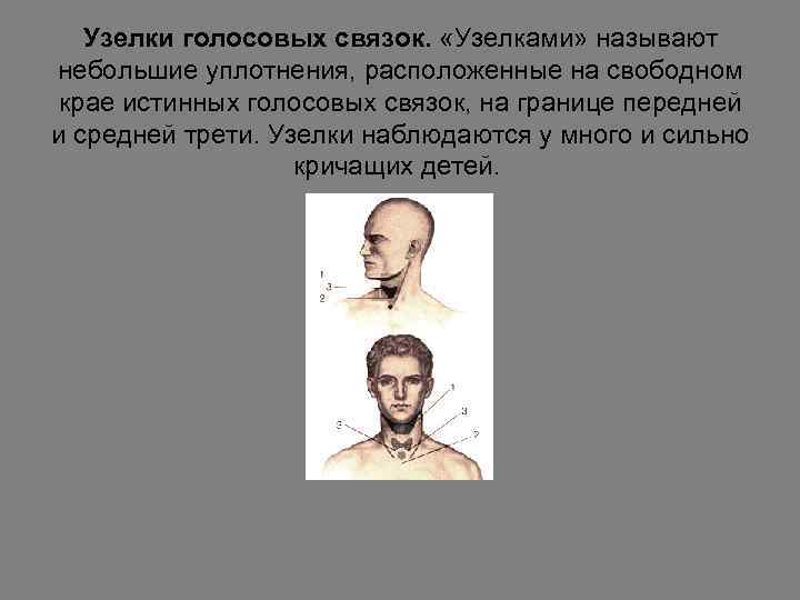 Узелки голосовых связок. «Узелками» называют небольшие уплотнения, расположенные на свободном крае истинных голосовых связок,