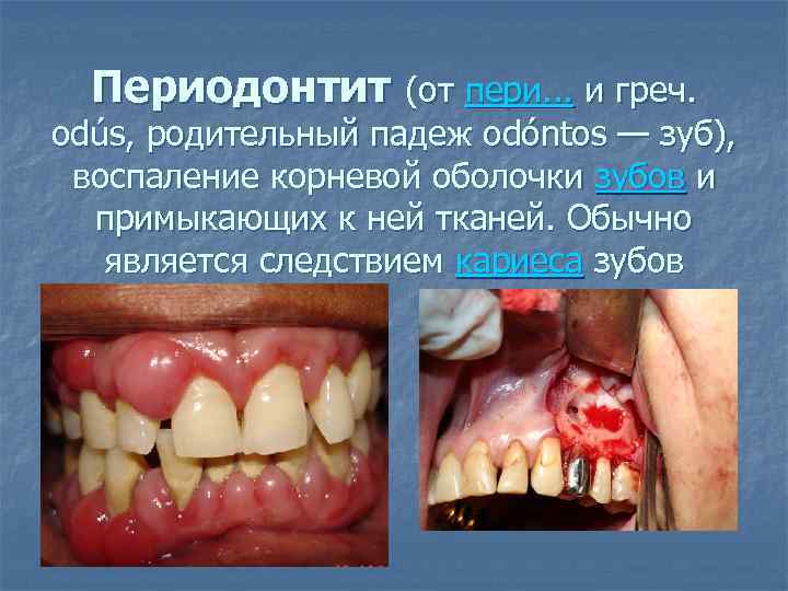 Периодонтит (от пери. . . и греч. odús, родительный падеж odóntos — зуб), воспаление