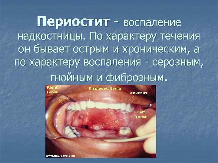 Периостит воспаление надкостницы. По характеру течения он бывает острым и хроническим, а по характеру