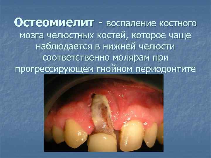 Остеомиелит воспаление костного мозга челюстных костей, которое чаще наблюдается в нижней челюсти соответственно молярам