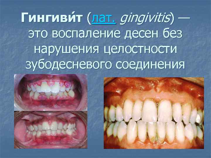 Гингиви т (лат. gingivitis) — это воспаление десен без нарушения целостности зубодесневого соединения 