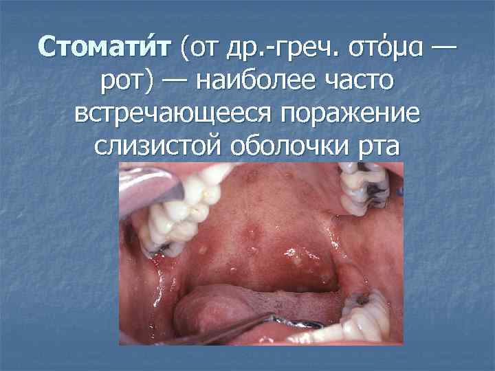 Стомати т (от др. греч. στόμα — рот) — наиболее часто встречающееся поражение слизистой