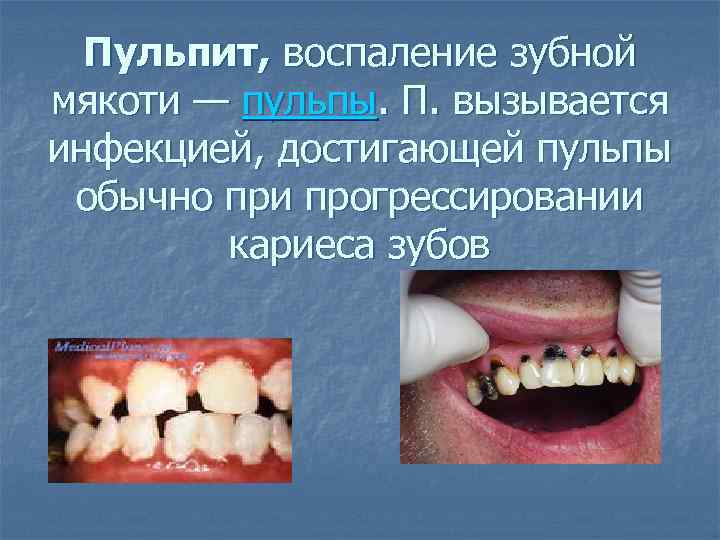 Пульпит, воспаление зубной мякоти — пульпы. П. вызывается инфекцией, достигающей пульпы обычно при прогрессировании