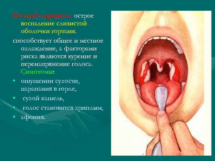Острый ларингит- острое воспаление слизистой оболочки гортани. способствует общее и местное охлаждение, а факторами