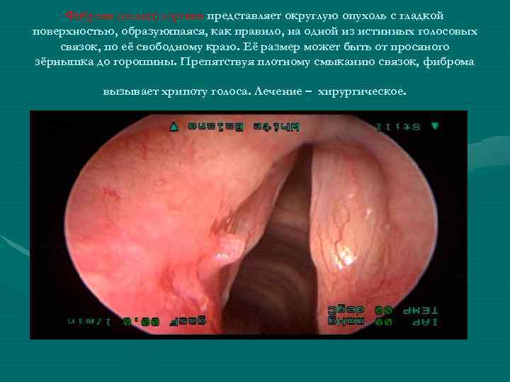 Фиброма (полип) гортани представляет округлую опухоль с гладкой поверхностью, образующаяся, как правило, на одной
