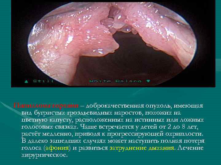 Папиллома гортани – доброкачественная опухоль, имеющая вид бугристых гроздьевидных наростов, похожих на цветную капусту,
