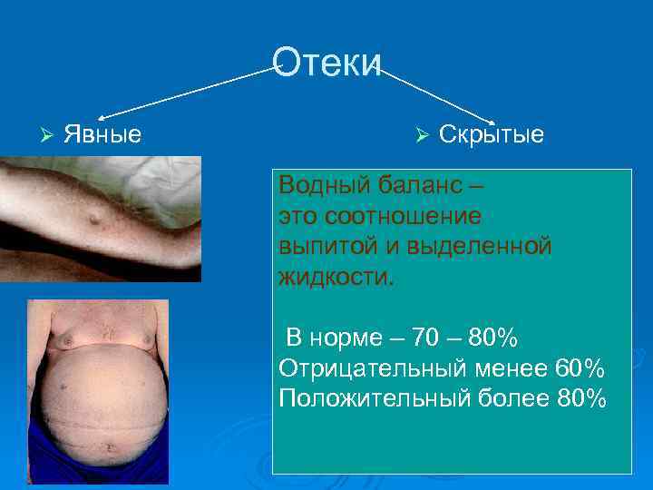 Отеки Ø Явные Ø Скрытые Водный баланс – это соотношение выпитой и выделенной жидкости.