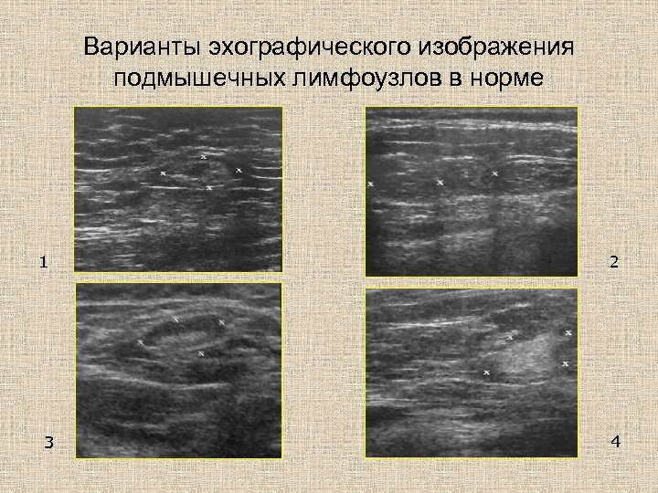 Варианты эхографического изображения подмышечных лимфоузлов в норме 1 3 2 4 