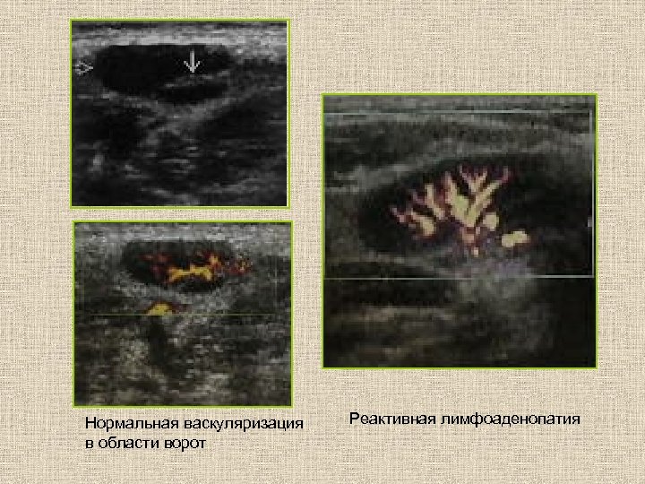 Нормальная васкуляризация в области ворот Реактивная лимфоаденопатия 