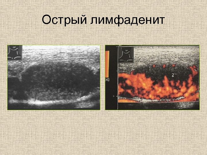 Острый лимфаденит 