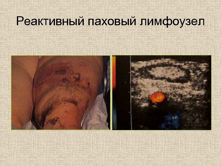 Реактивный паховый лимфоузел 