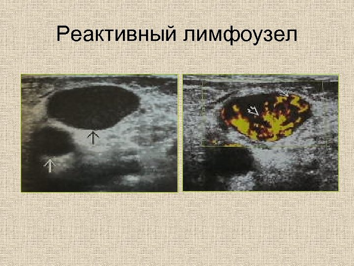 Реактивный лимфоузел 