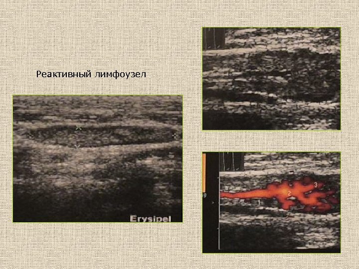 Реактивный лимфоузел 