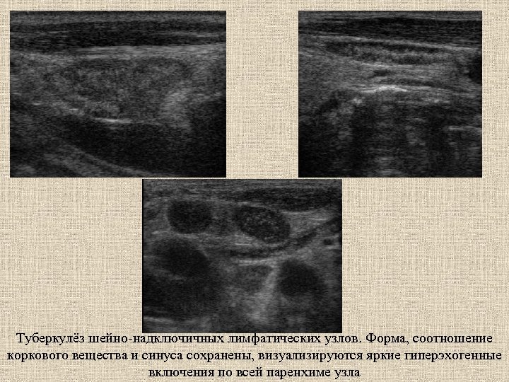 Туберкулёз шейно-надключичных лимфатических узлов. Форма, соотношение коркового вещества и синуса сохранены, визуализируются яркие гиперэхогенные