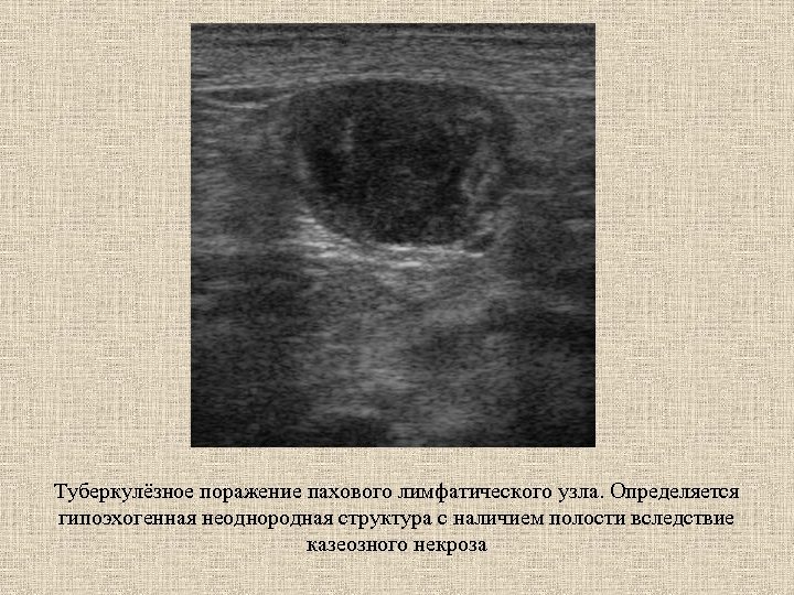 Туберкулёзное поражение пахового лимфатического узла. Определяется гипоэхогенная неоднородная структура с наличием полости вследствие казеозного