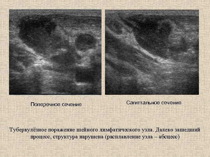 Поперечное сечение Сагиттальное сечение Туберкулёзное поражение шейного лимфатического узла. Далеко зашедший процесс, структура нарушена