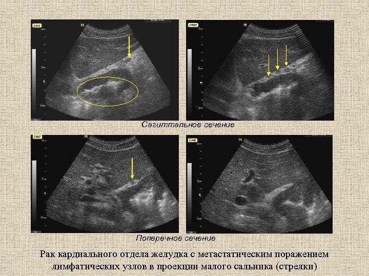 Сагиттальное сечение Поперечное сечение Рак кардиального отдела желудка с метастатическим поражением лимфатических узлов в