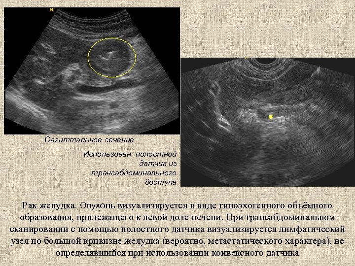 Сагиттальное сечение Использован полостной датчик из трансабдоминального доступа Рак желудка. Опухоль визуализируется в виде