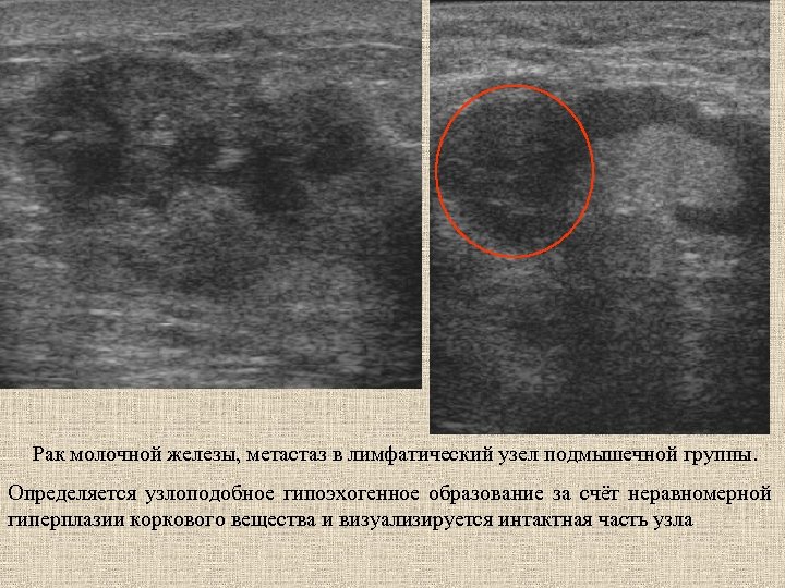 Рак молочной железы, метастаз в лимфатический узел подмышечной группы. Определяется узлоподобное гипоэхогенное образование за