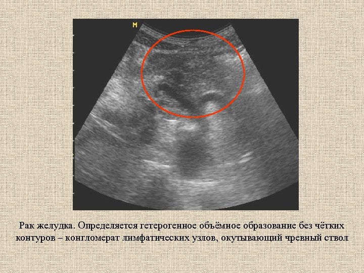Рак желудка. Определяется гетерогенное объёмное образование без чётких контуров – конгломерат лимфатических узлов, окутывающий
