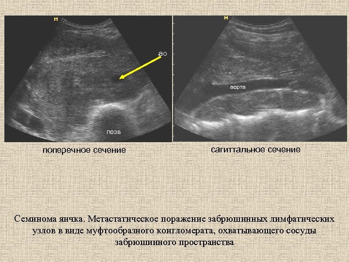 ао аорта позв поперечное сечение сагиттальное сечение Семинома яичка. Метастатическое поражение забрюшинных лимфатических узлов