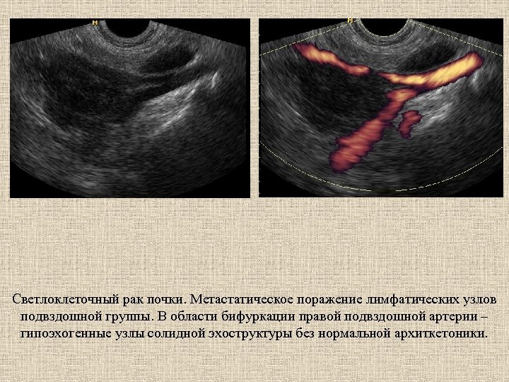 Светлоклеточный рак почки. Метастатическое поражение лимфатических узлов подвздошной группы. В области бифуркации правой подвздошной