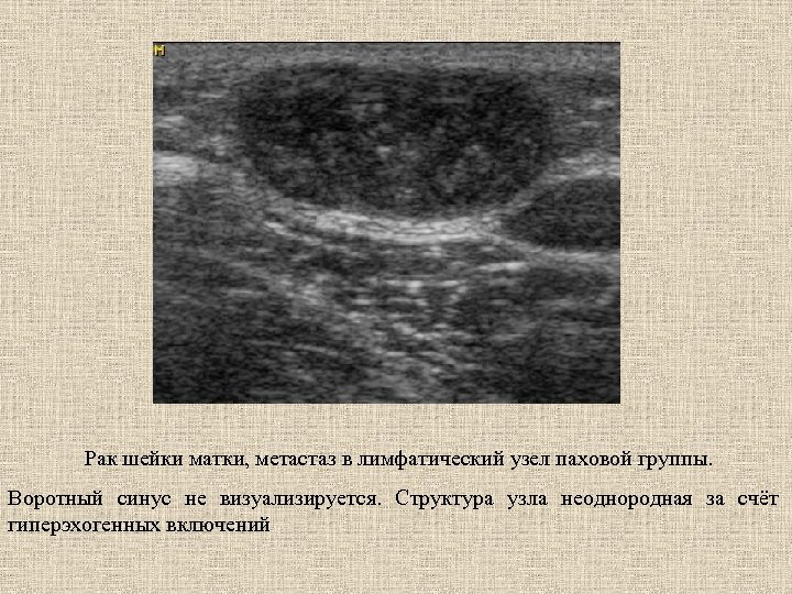 Рак шейки матки, метастаз в лимфатический узел паховой группы. Воротный синус не визуализируется. Структура