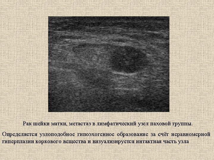 Рак шейки матки, метастаз в лимфатический узел паховой группы. Определяется узлоподобное гипоэхогенное образование за