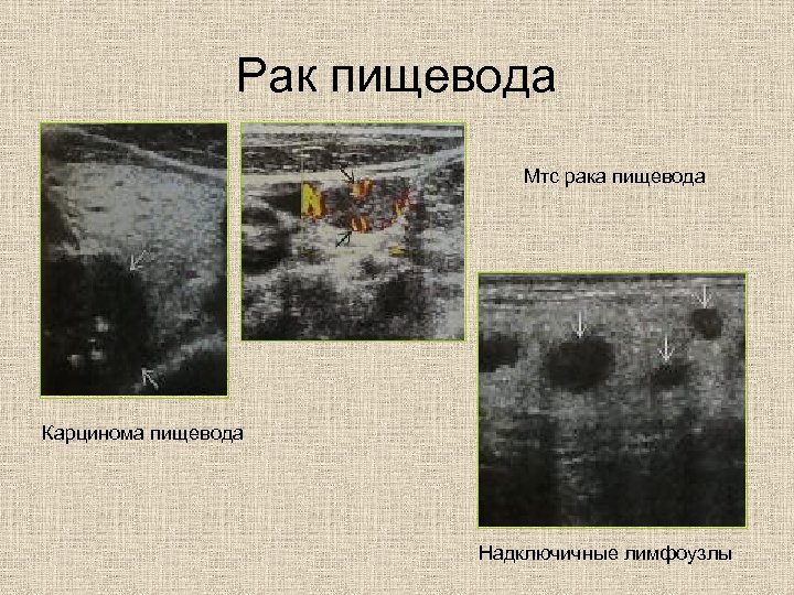 Рак пищевода Мтс рака пищевода Карцинома пищевода Надключичные лимфоузлы 