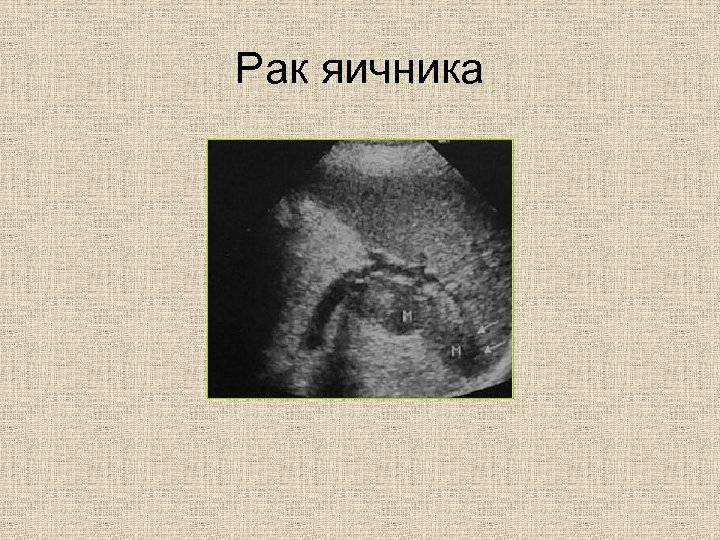 Рак яичника 