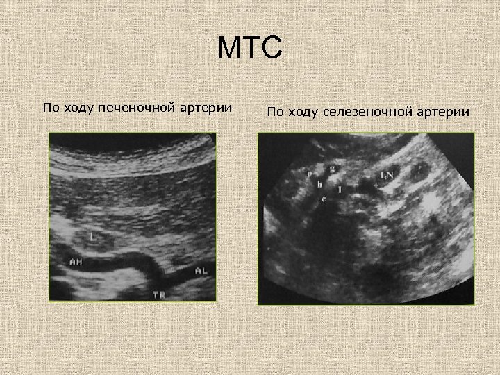 МТС По ходу печеночной артерии По ходу селезеночной артерии 