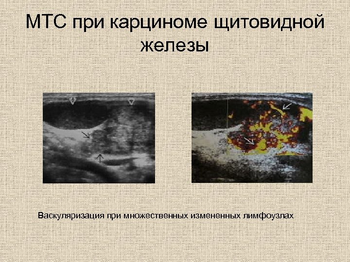 МТС при карциноме щитовидной железы Васкуляризация при множественных измененных лимфоузлах 